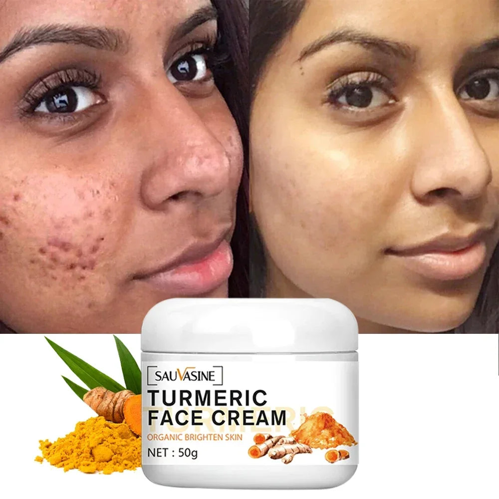 Magic Turmeric Face Cream Acne Treatment Dark Spots Removal Moisturizing Brightening Whitening Cream for Dark Skin Care Beauty Health